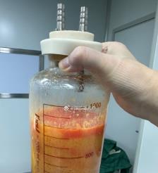 射阳水动力吸脂手术要做多久？